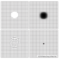 Amsler Grid Test- Retina Ophthalmology Gettysburg PA - Greater Potomac  Retina