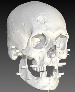 用组织深度标记对JB55的颅骨进行3D扫描，帮助指导面部重建。