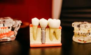 Dentures at Renaissance Dental
