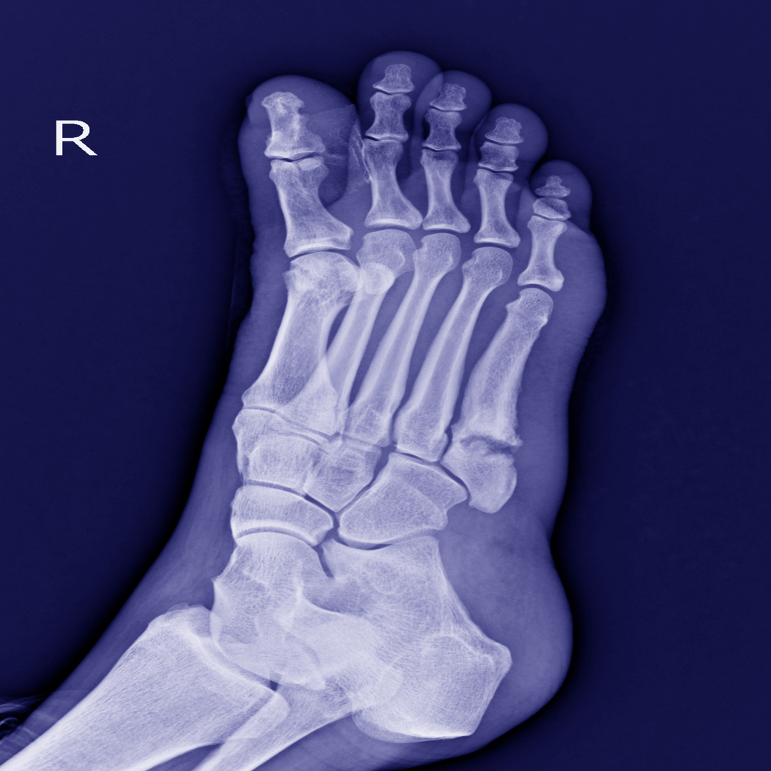 Stryker Dominates Global Small Bone and Joint Market, with DePuy ...