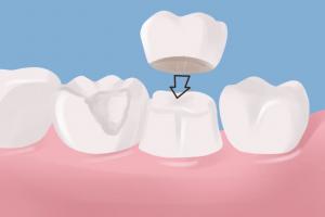 Revitalize your smile with strong and aesthetic crowns.  Trust the expertise of Dr.  Matthew S. Wittrig, DDS in Greenwood, IN for Personalized Dental Care & Durable Solutions for Improved Oral Health and Function.