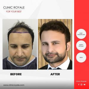 Clinic Royale - Hair Transplant Before/After