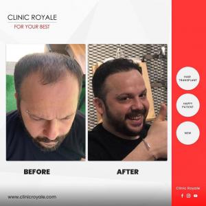 Clinic Royale - Hair Transplant Center