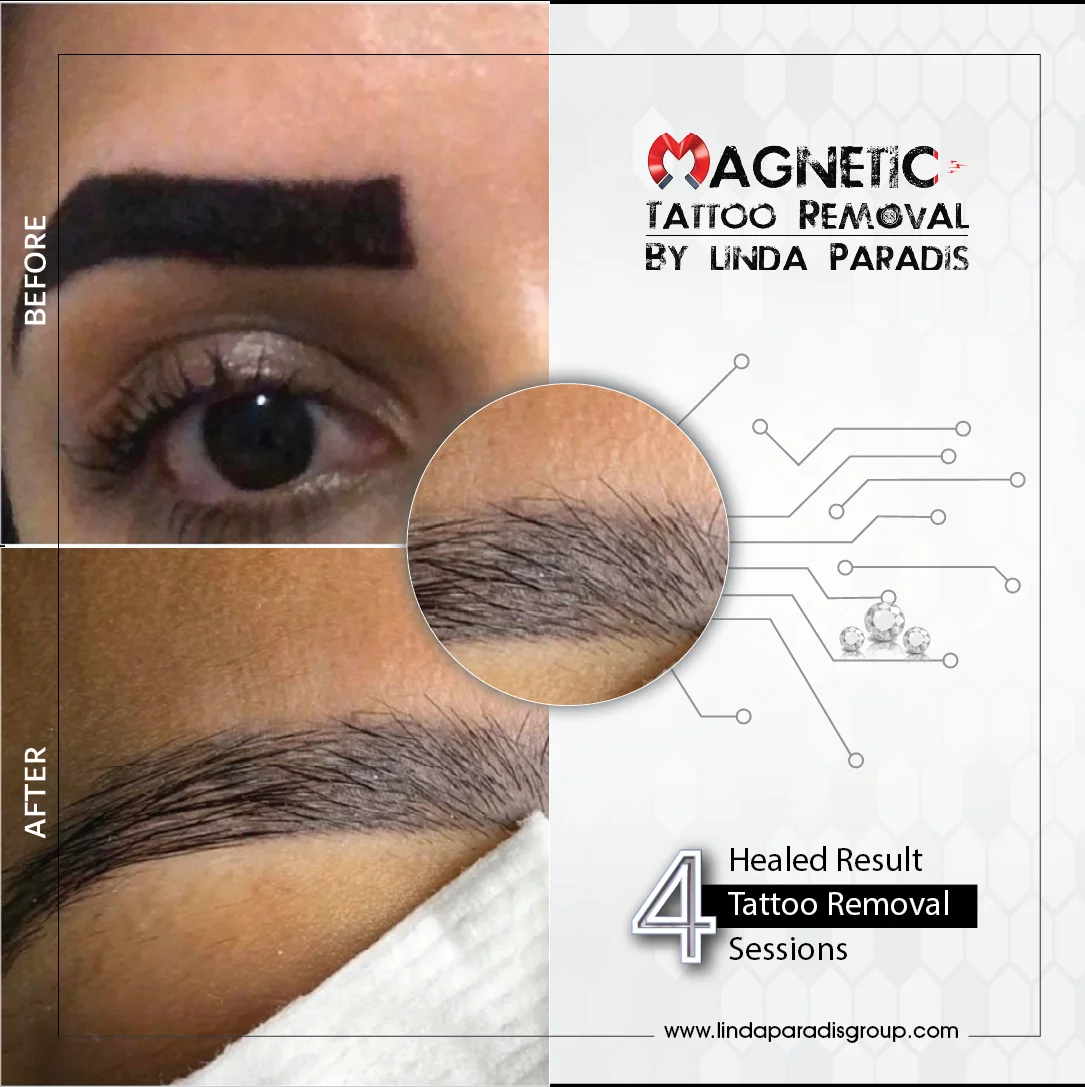 The New Generation of MAGNETIC Tattoo Removal technique finally tested and  ready to be used EDERMIS TATTOO REMOOV