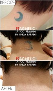 Magnetic Tattoo Removal vanish the tattoo