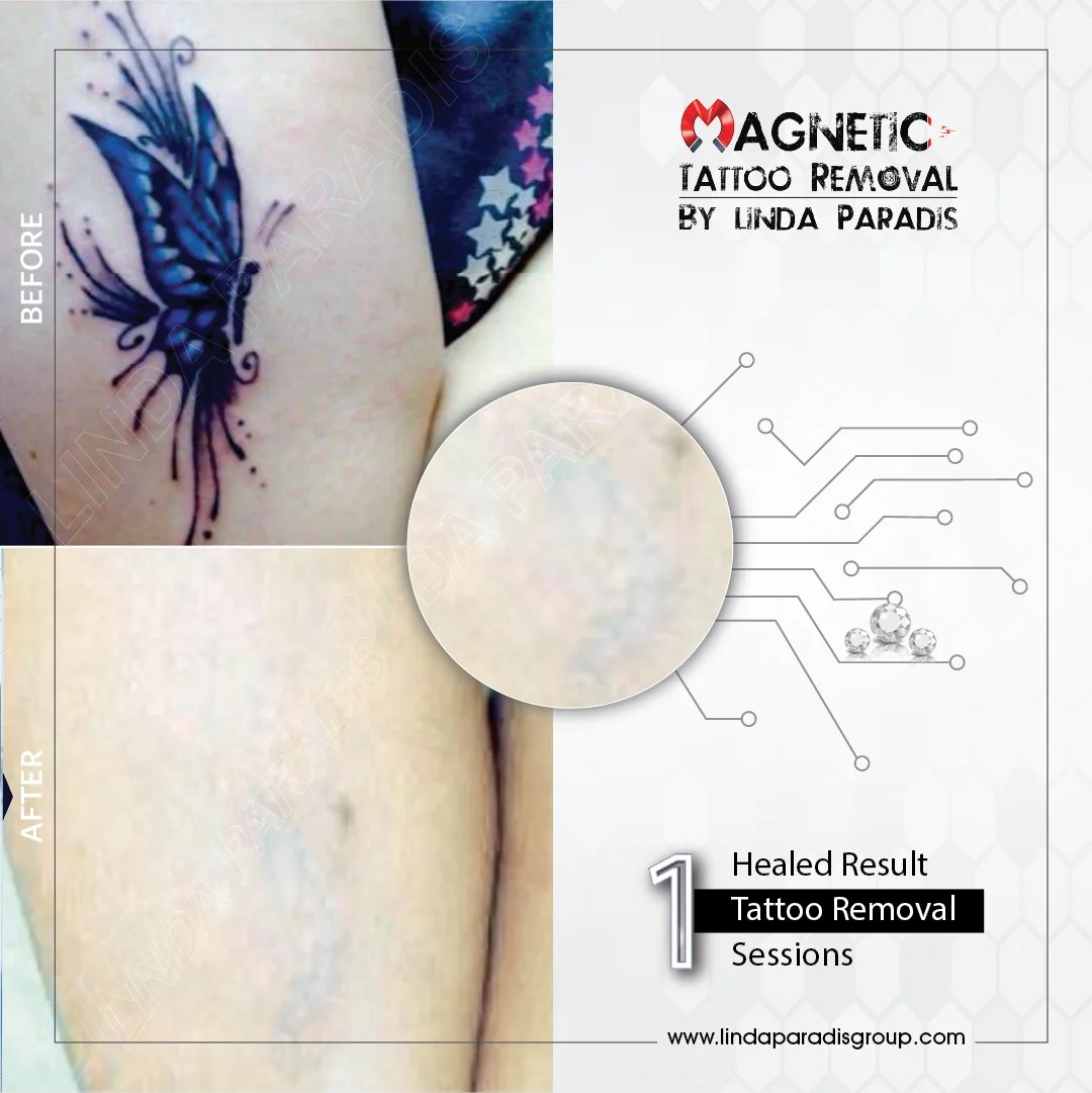 Comparison Between Magnetic Tattoo Removal And Laser Tattoo Removal
