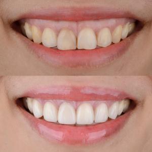 Gummy Smile Treatment in Beverly Hills by Dr. Alex Farnoosh