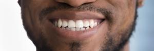 Gum Depigmentation & Gum Bleaching in Beverly Hills - Dr. Alex Farnoosh - The Total Smile