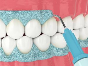 Gum Bleaching Treatment in Beverly Hills - Dr. Alex Farnoosh - The Total Smile