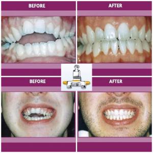 Open Bite Case Before and After