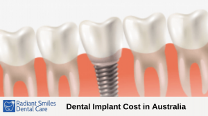 Dental Implants Cost in Australia