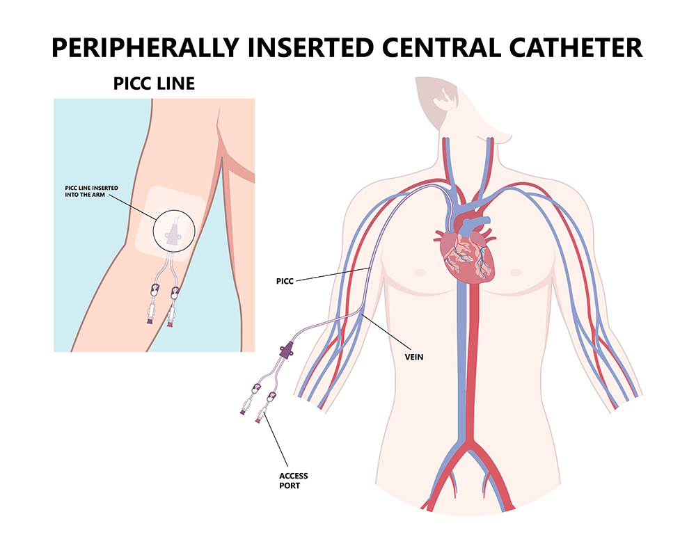 Vigna Law Group Announces PICC Line Legal Help Desk for Blood Clots and  Infections