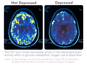 Before After TMS scan