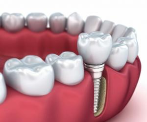 Dental implants perth image