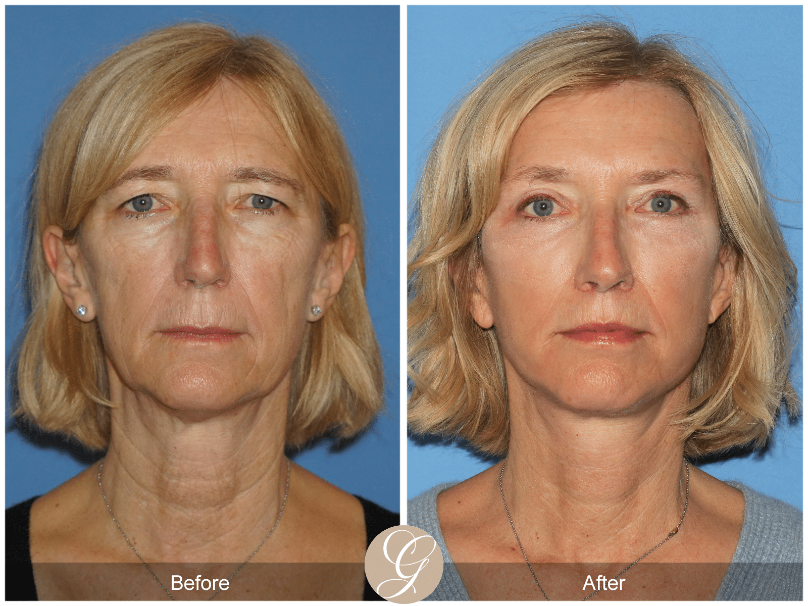 Facelift Misconceptions & Deep Plane Facelift for Natural Look