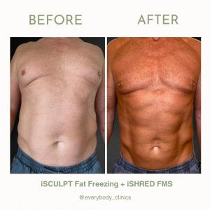 Fat Freeze Results on Male Client