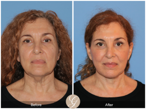 https://drkevinsadati.com/gallery/facelift/deep-plane-facelift/