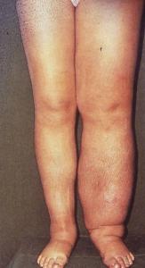 Lymphedema of the leg