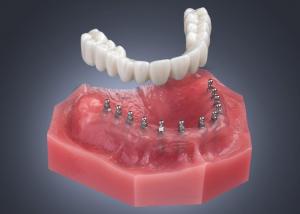 Implant Dentures | Mint Mini Dental Implants