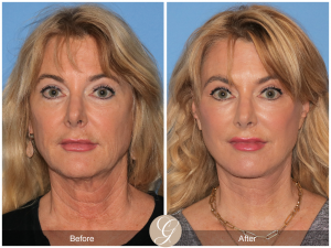 https://drkevinsadati.com/gallery/facelift/deep-plane-facelift/02/