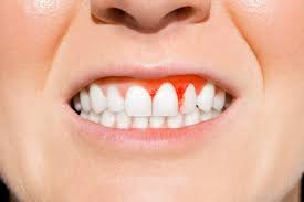 Market Overview:
The gingivitis market reached a value of US$ 4