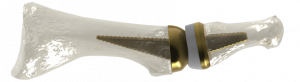 Image of a Model of the Anatomic Great Toe Joint