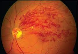 Market Overview:
The retinal vein occlusion market reached a value of US$ 2,656