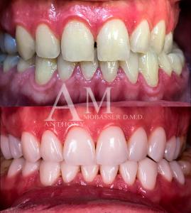 Porcelain Veneers-Los Angeles-Before-and-After-Veneers