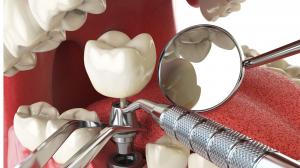 Dental IMplants treatment