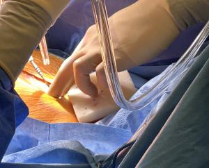 SWICKER in surgical procedure