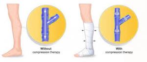 compression_therapy_Industry