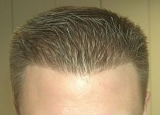 Natural Hairline Hair Systems