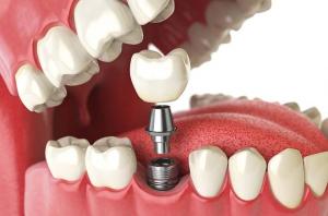 Dental Implants And Prosthesis industry
