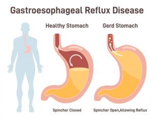 Gastroesophageal Reflux Disease Treatment Devices Market 2024