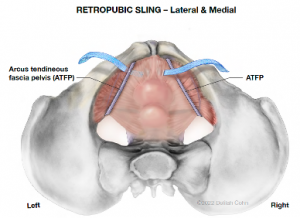 Photo of retropubic sling location