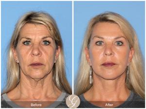 Women in their early 60s who had a Preservation facelift with Dr.  Kevin Sadati
