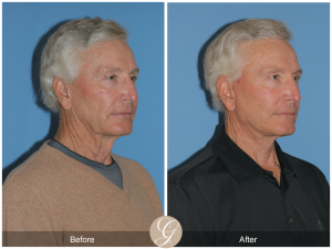Facelift For a man in his 70s