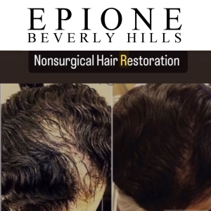 Before and after images of nonsurgical hair restoration from Epione Beverly Hills, showing significant hair regrowth and improved hair density