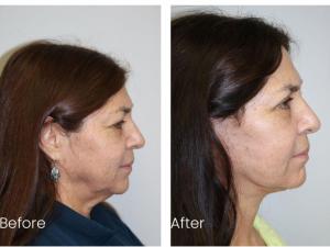 21347665 facelift before and after