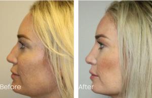 21347666 rhinoplasty before and after ph