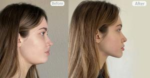 Before and after effects of face yoga