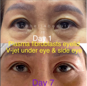 the differnece plasma fibroblast can do with a non invasive v-jet