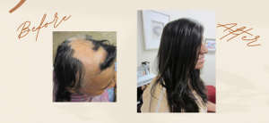 Non-surgical hair loss treatment