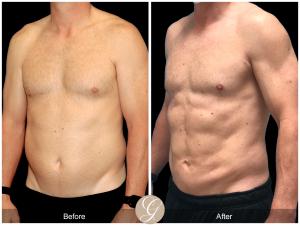 Male Hi-Def Body Contouring using Vaser Liposuction