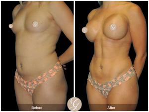 Female Hi-Def Body Contouring with Vaser Liposuction.