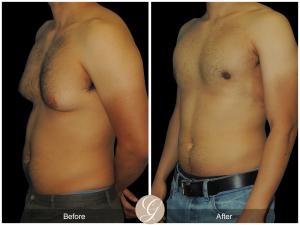 Male Gynecomastia Removal