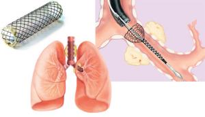 Lung Stent Market 2024-2032