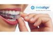 Epsom, Auckland Invisalign Straighteners & Smile Correction Devices Announced