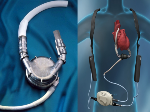 Cardiac Assist Devices Market 2025