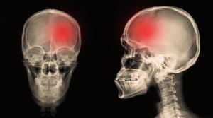 Migraine treatment is commonly managed in primary care through a combination of symptom review, diagnosis, trigger discussion, acute treatment planning, preventive care, medication monitoring, and referral when needed head injury